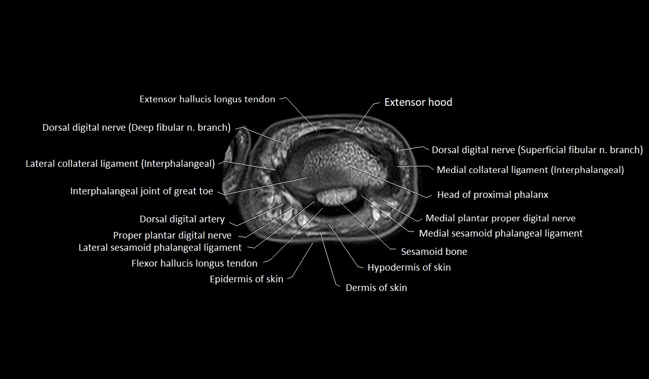 Great toe (hallux) axial microanatomy 3T MRI image 12.webp